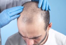 Hair Transplants