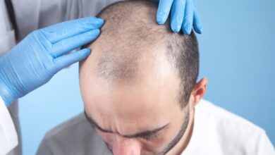 Hair Transplants