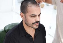 Everything You Need to Know About Hair Transplant Turkey Cost in 2025