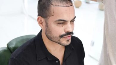 Everything You Need to Know About Hair Transplant Turkey Cost in 2025