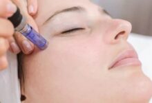 Microneedling in Brighton