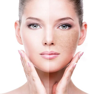 Dermatologist-Created Pigmentation Treatment Brought to Your Door Lavié’s Advantage