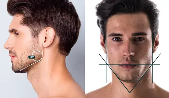 Jawline Fillers