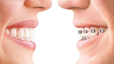 Traditional Braces
