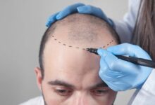 Medical Tourism - Hair Transplant Turkey