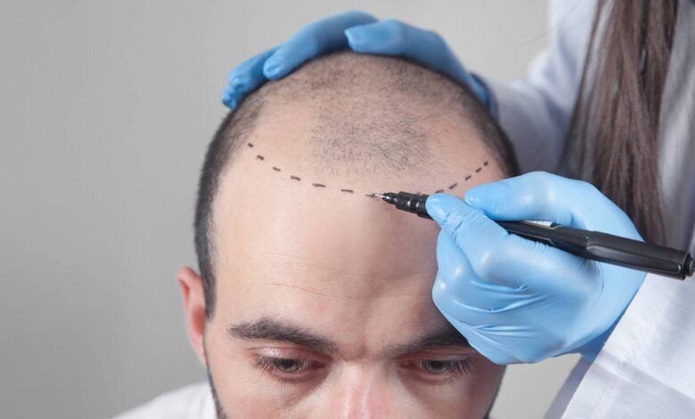 Medical Tourism - Hair Transplant Turkey