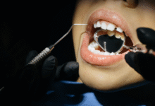 Dental Implants