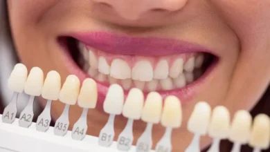 Veneers