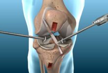 ACL Tear Surgery