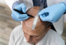Hair Transplant in Turkey