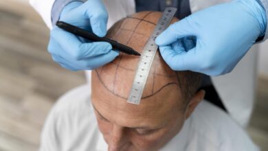 Hair Transplant in Turkey