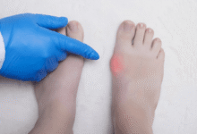 Recovery After Bunion Surgery