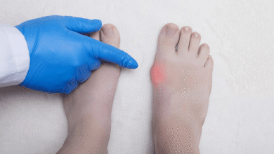Recovery After Bunion Surgery