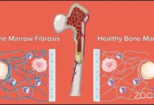 Stem Cell Myelofibrosis Treatment and Procedures: A Complete Patient Guide