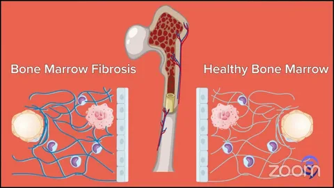 Stem Cell Myelofibrosis Treatment and Procedures: A Complete Patient Guide