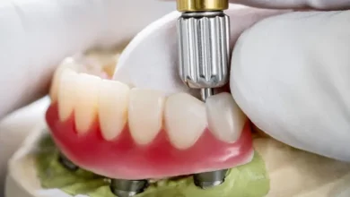Dental Implants Newcastle