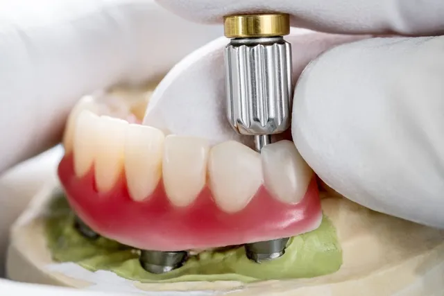 Dental Implants Newcastle