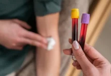 Biomarkers